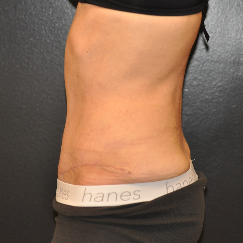 Front View Tummy Tuck Before and After Photo by Dr. Steely in Houston, TX