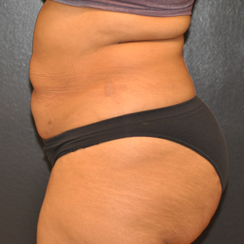 Left Side View Tummy Tuck Before and After Photo by Dr. Steely in Houston, TX