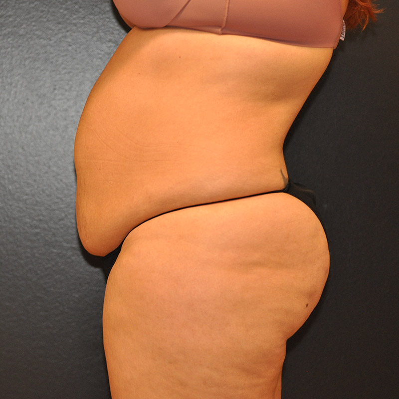 Left Side View Tummy Tuck Before and After Photo by Dr. Steely in Houston, TX