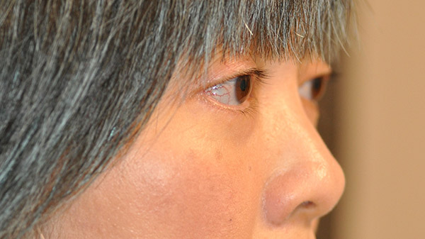 Right Oblique View Lower Lid Blepharoplasty Before and After Photo by Dr. Steely in Houston, TX