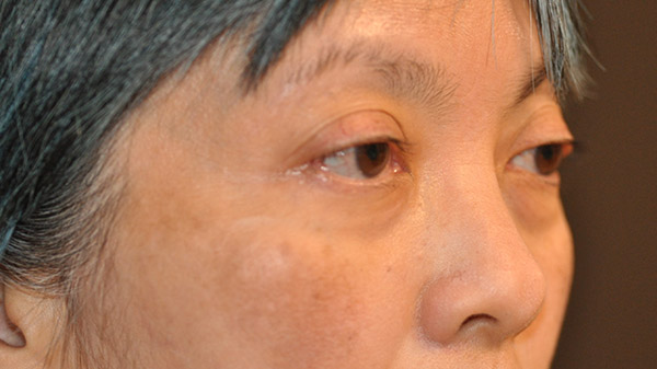 Right Oblique View Lower Lid Blepharoplasty Before and After Photo by Dr. Steely in Houston, TX