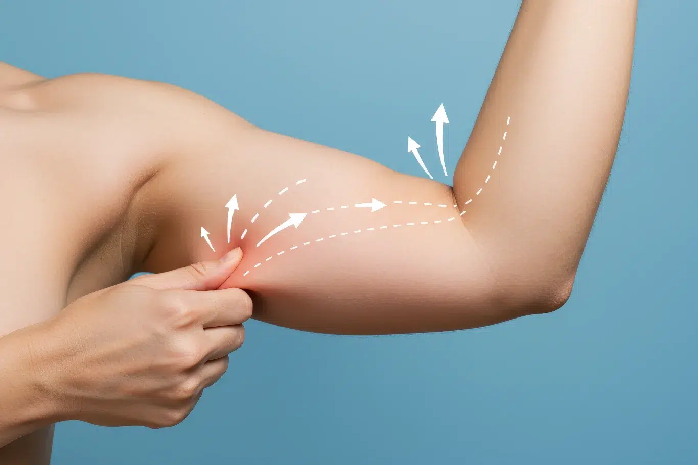 person pinching upper arm loose skin with white graphic arrows indicating surgical tightening paths for arm lift surgery