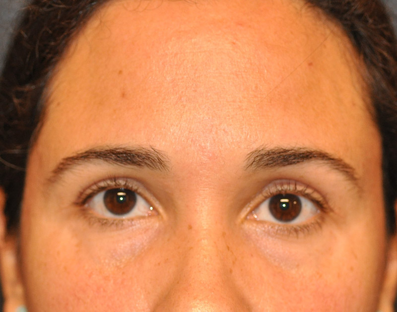 Front View Brow Lift Before and After Photo by Dr. Steely in Houston, TX