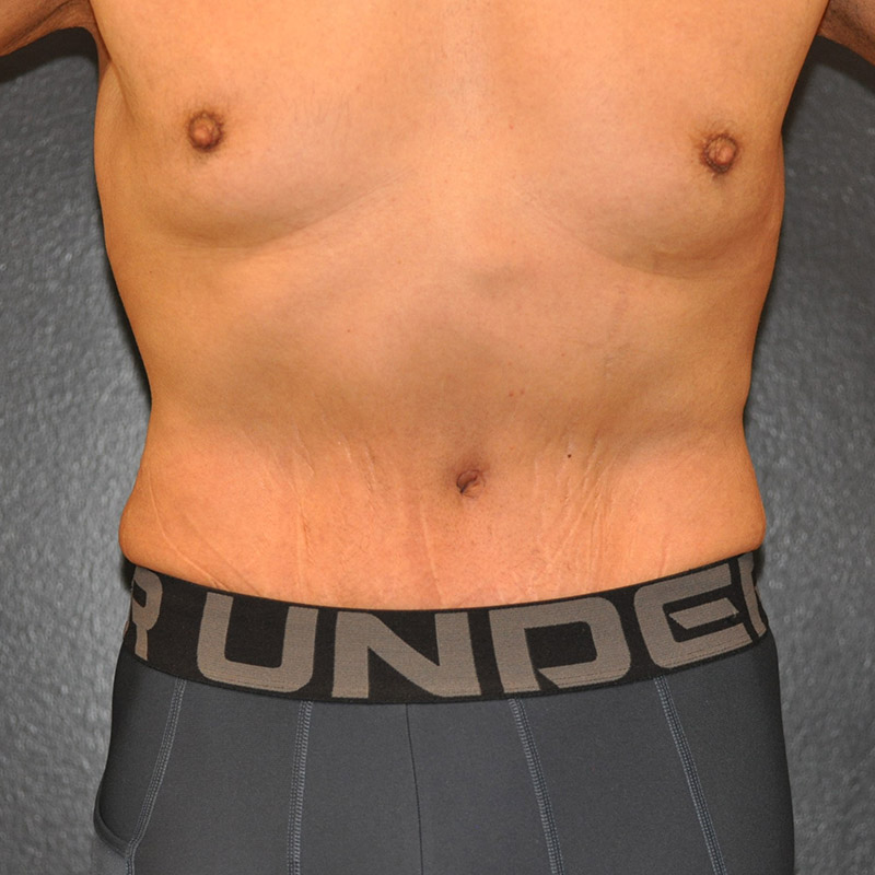Front View Liposuction Before and After Photo by Dr. Steely in Houston, TX