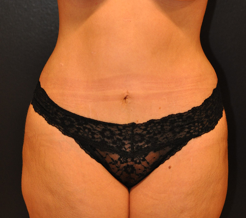 Front View Mini Tummy Tuck Before and After Photo by Dr. Steely in Houston, TX