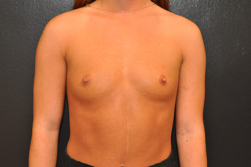 Front View Breast Augmentation Before and After Photo by Dr. Steely in Houston, TX