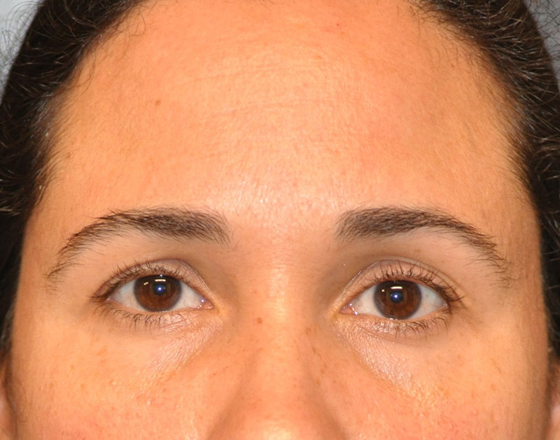 Front View Brow Lift Before and After Photo by Dr. Steely in Houston, TX