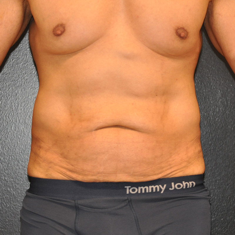 Front View Liposuction Before and After Photo by Dr. Steely in Houston, TX