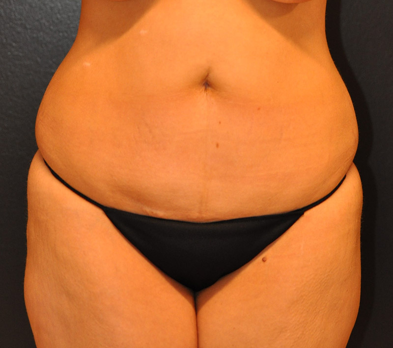 Front View Mini Tummy Tuck Before and After Photo by Dr. Steely in Houston, TX