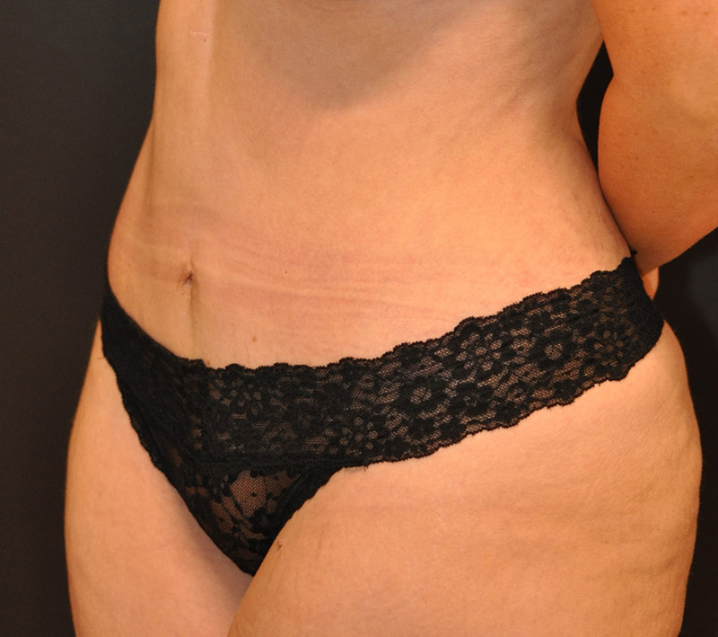 Left oblique View Mini Tummy Tuck Before and After Photo by Dr. Steely in Houston, TX