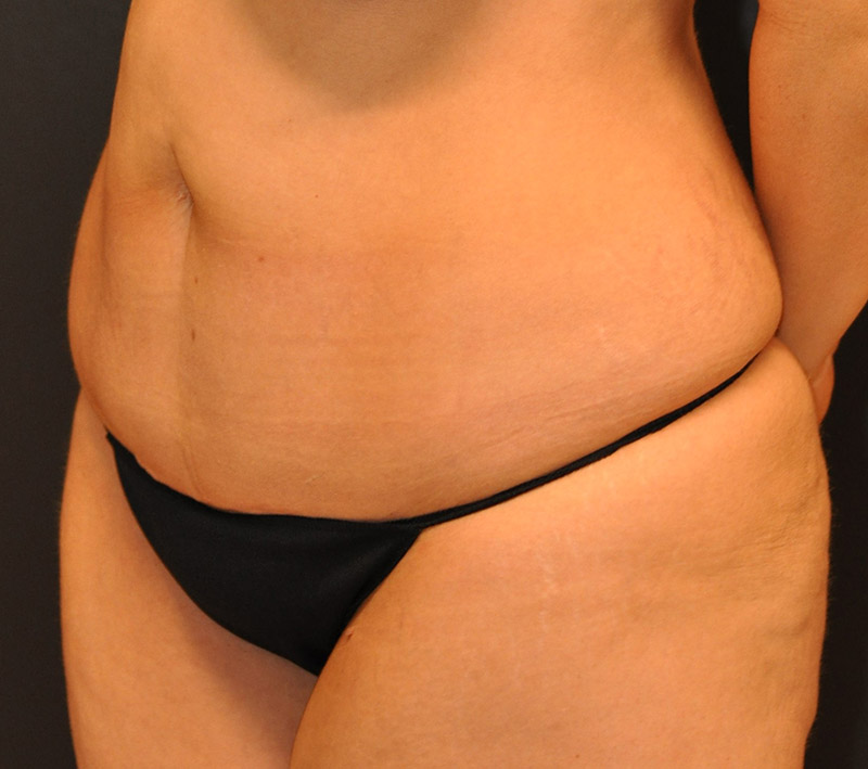Left oblique View Mini Tummy Tuck Before and After Photo by Dr. Steely in Houston, TX