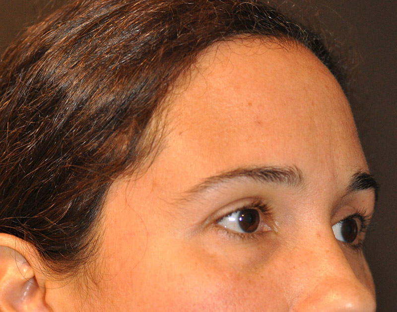 Right oblique View Brow Lift Before and After Photo by Dr. Steely in Houston, TX