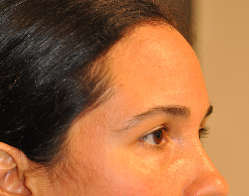 Right oblique View Brow Lift Before and After Photo by Dr. Steely in Houston, TX